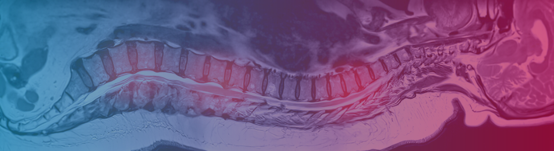 Spine image before pain pump procedure